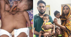 ঢামেকে সফল অস্ত্রোপচার: আলাদা হলো শিশু শিফা-রিফা