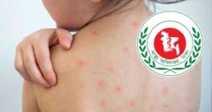 হাম উপসর্গে প্রাণ গেল আরও ৮ শিশুর, আক্রান্ত ৭৯৮