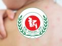 দেশে হাম ও উপসর্গে মৃত্যু ১১০০ ছাড়ালো