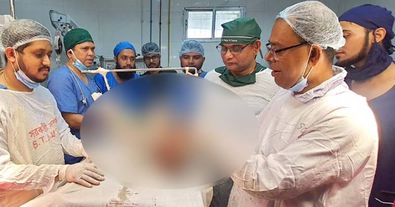 শিশুর ভেতরে আরেক শিশু: তাজউদ্দীন মেডিকেলের চিকিৎসকদের দক্ষতায় অপসারণ