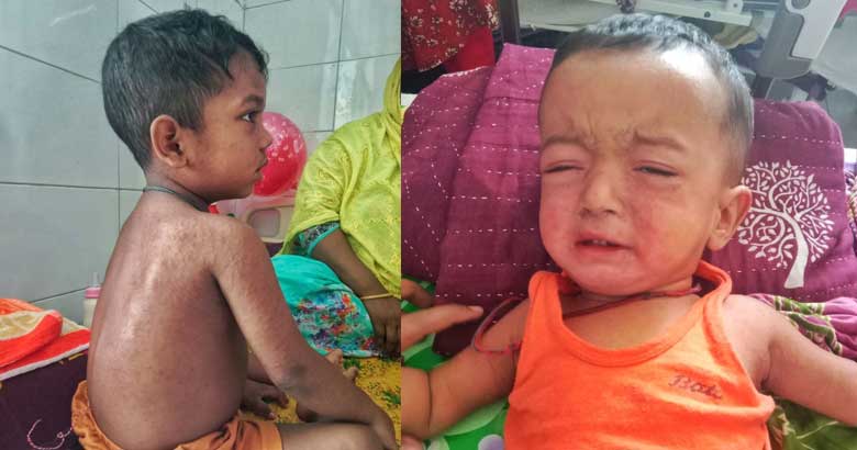 গাজীপুর তাজউদ্দীন মেডিকেলে ভর্তি সক্ষমতার দ্বিগুণ হামে আক্রান্ত শিশু