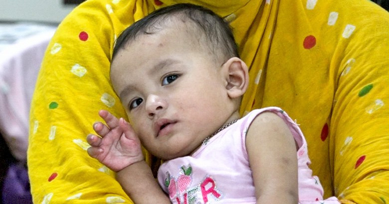 হামের উপসর্গে আরও ৪ শিশুর মৃত্যু, মোট মৃত ২৮০