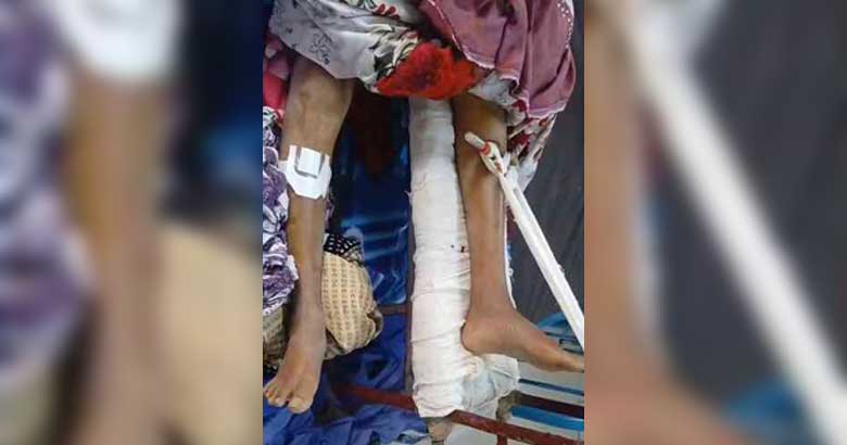 ভারতে চিকিৎসায় অবহেলার অভিযোগ, ভাঙা পা রেখে সুস্থ পায়ে অস্ত্রোপচার